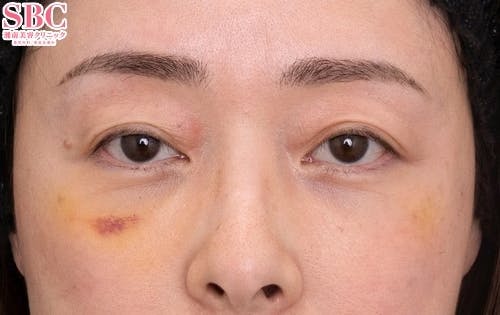 【40代女性・目元】目の下の切らないクマ・たるみ（ふくらみ）取り、ナチュラル脂肪注射コンデンスリッチ_1week