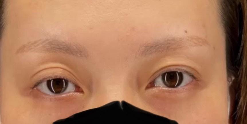 湘南美容クリニック 新橋銀座口院で切開法：眼瞼下垂を受けたふーみんさんの写真