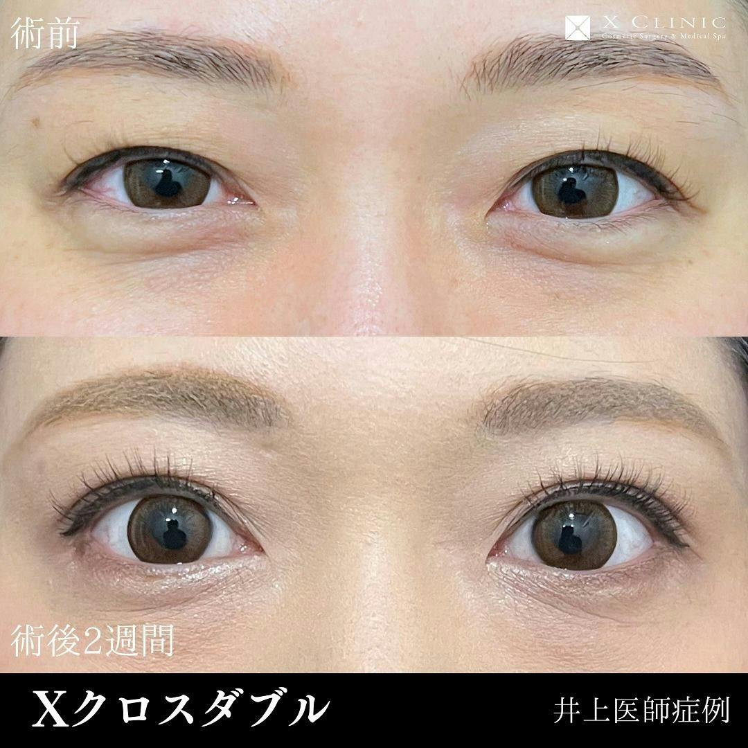 【30代女性・目元】Xクロスダブル_before_aftar