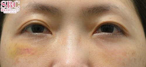 【女性・目元】目の下の切らないクマ・たるみ（ふくらみ）取り、ナチュラル脂肪注射コンデンスリッチ_1week