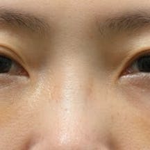 【女性・目元】目の下の切らないクマ・たるみ(ふくらみ)取り、ナチュラル脂肪注射コンデンスリッチ_1week