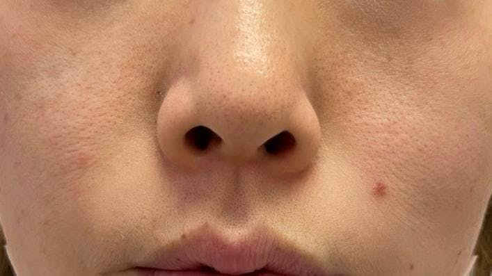 聖心美容クリニック 銀座院で鼻の整形：鼻孔縁下降術を受けた清田さんの写真
