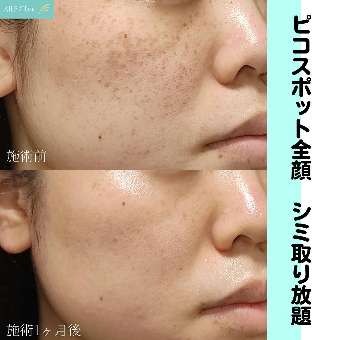 【女性・頬】ピコスポット全顔シミ取り放題_before_aftar