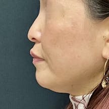 【40代女性・輪郭】ウルトラリフトダブルHIFU・ヒアルロン酸ジュビダームビスタ バイクロスシリーズ_before