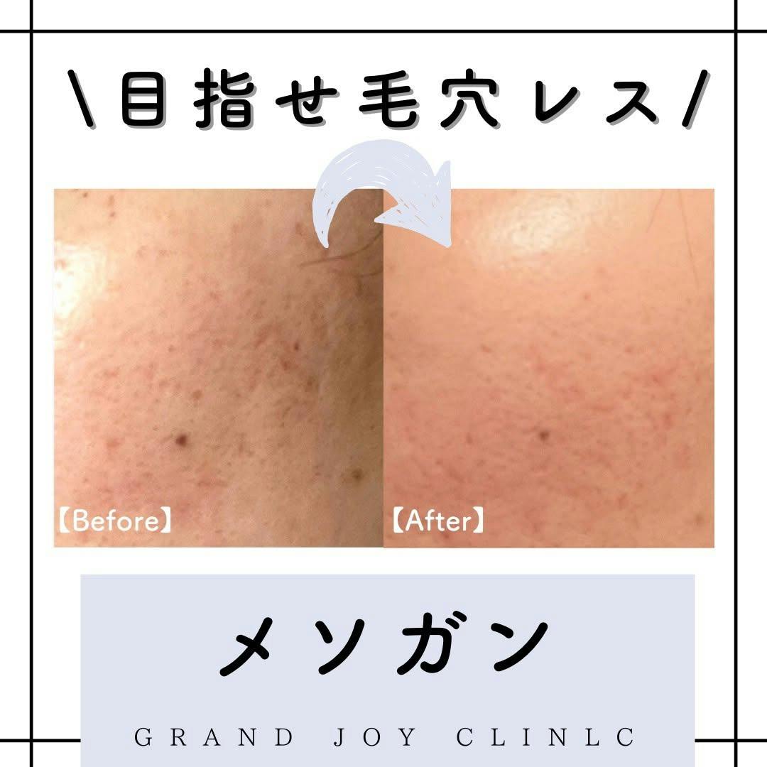 【毛穴】メソガン_before_aftar