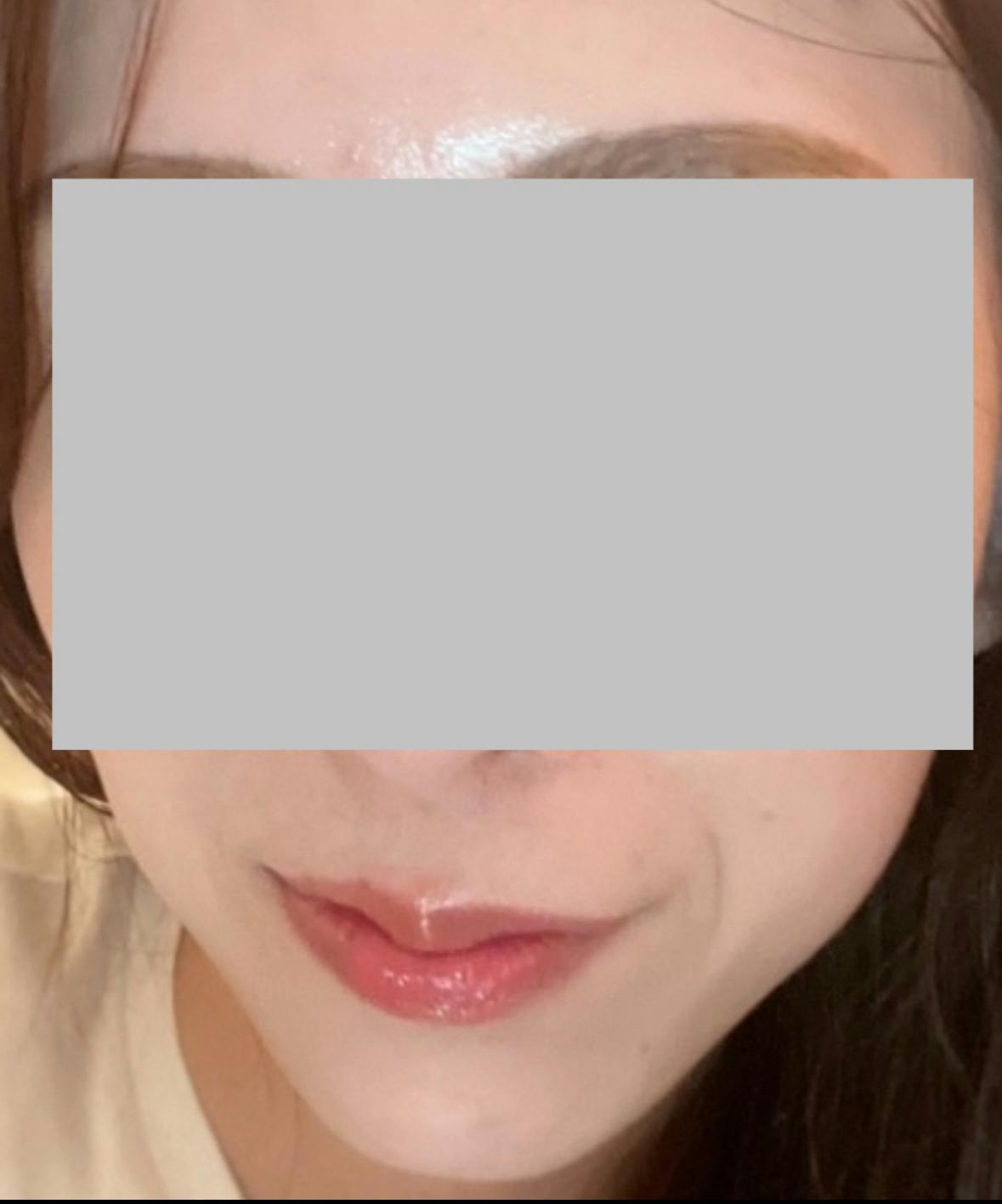 湘南美容クリニック 博多院でボトックス注射を受けたarai03さんの写真