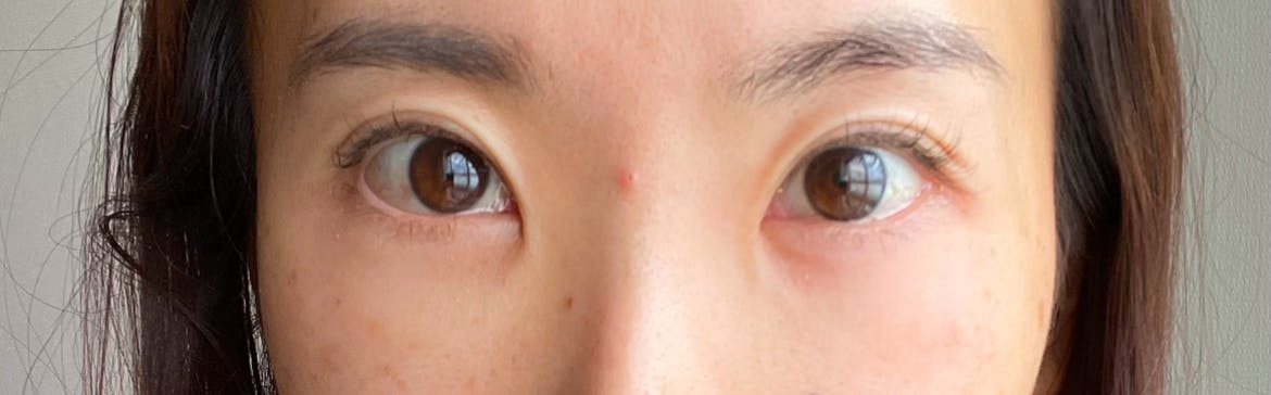 湘南美容クリニック 辻堂アカデミアで目の下のクマ・たるみ取りを受けたKazuminさんの写真