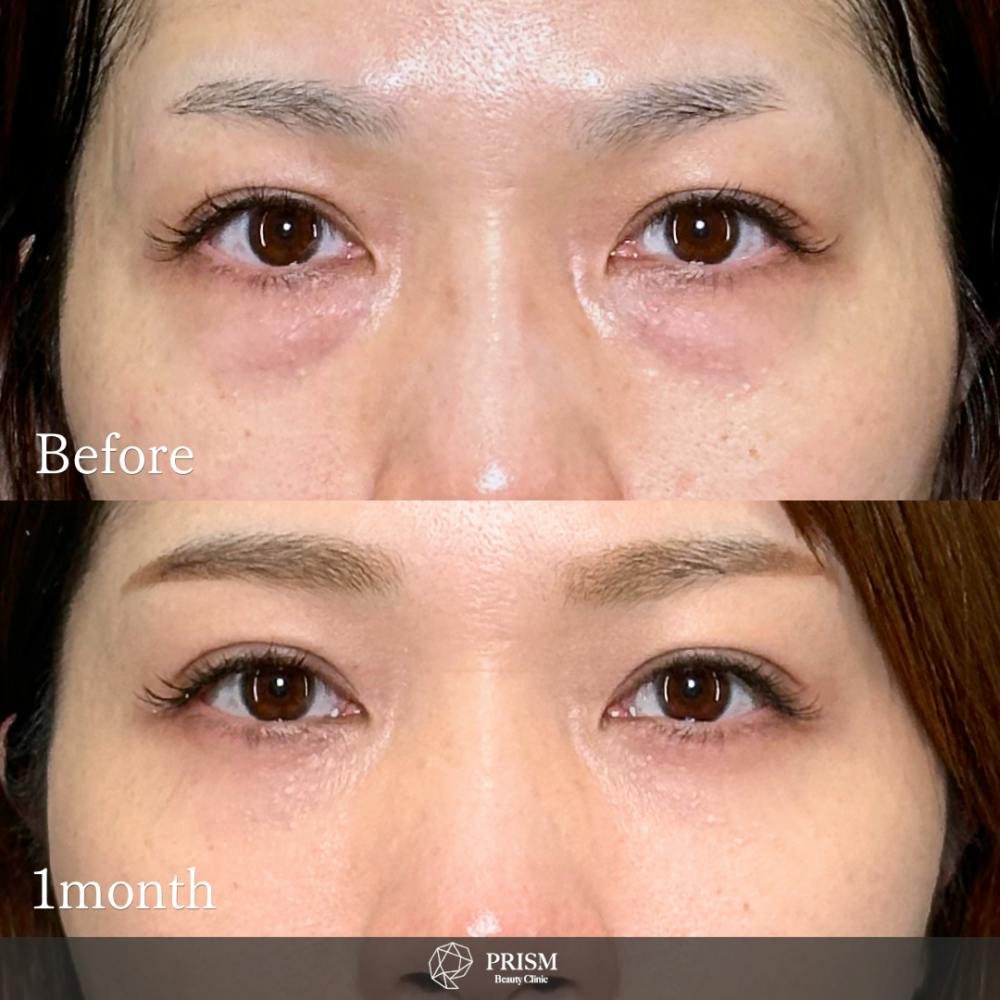 【40代女性・目】切らない目の下のクマ取り＋ヒアルロン酸（目の下）_before_aftar