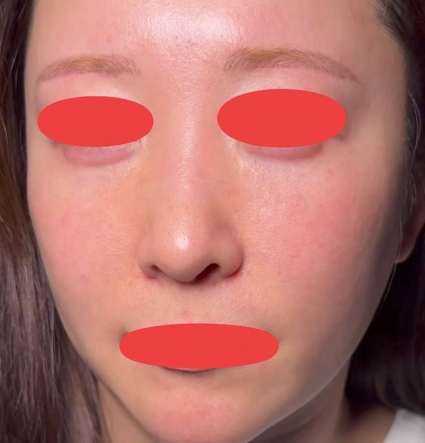 TCB東京中央美容外科 天王寺院で眉下リフト・スレッドリフト・メーラーファット除去・小顔脂肪吸引  ：眉下切開　TCB小顔リフト　メーラーファット除去　脂肪吸引を受けた山本さん家の美怜さんさんの写真