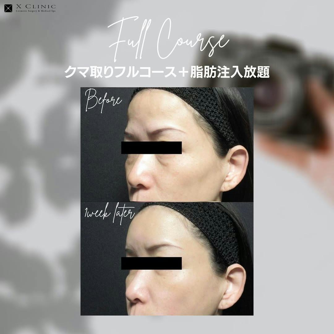【女性・目元】クマ取りフルコース＋ 脂肪注入_before_aftar