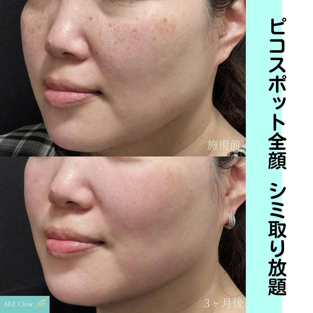 【女性・シミ】ピコスポット全顔_before_aftar