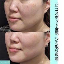 【女性・シミ】ピコスポット全顔_before_aftar
