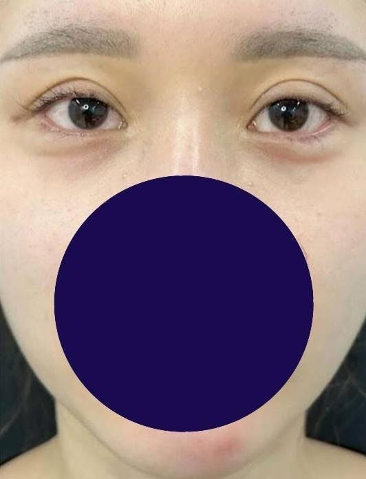 TCB東京中央美容外科 小倉院で二重整形・目元整形：目尻切開を受けたりゃんさんの写真