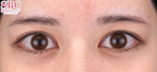 【20代女性・目元】クイックコスメティーク・トリプルNeo_before