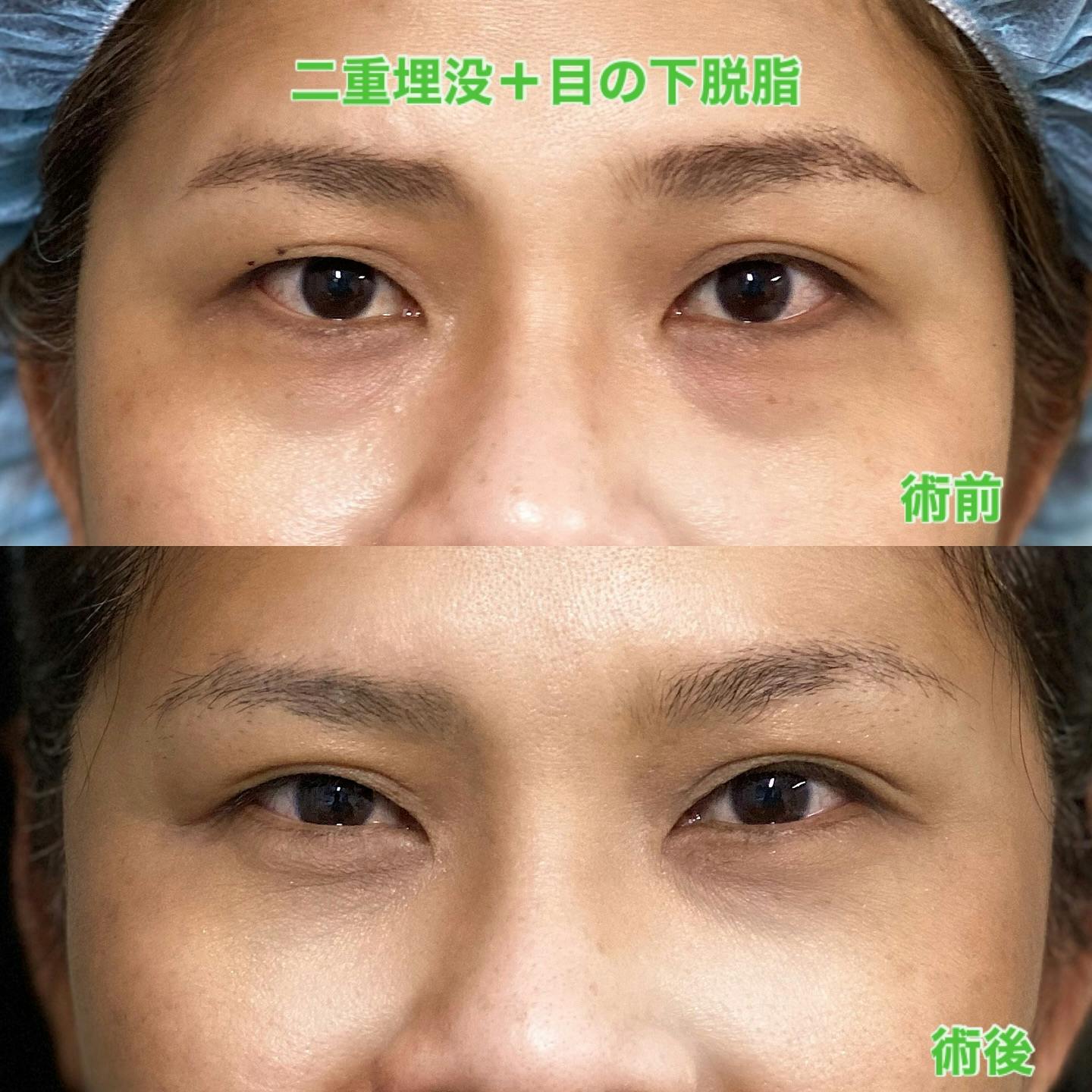 【目元】二重埋没＋目の下脱脂_before_aftar