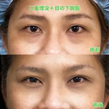 【目元】二重埋没+目の下脱脂_before_aftar