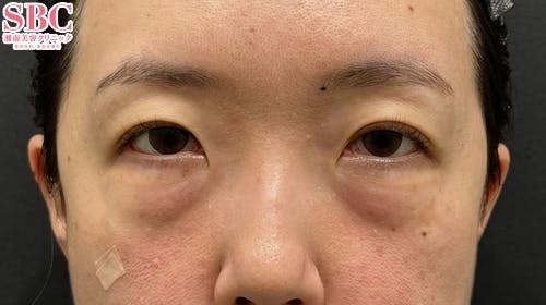 【40代女性・目元】目の下の切らないクマ・たるみ（ふくらみ）取り ナチュラル脂肪注射コンデンスリッチ ナチュラル脂肪注射ナノリッチ_before