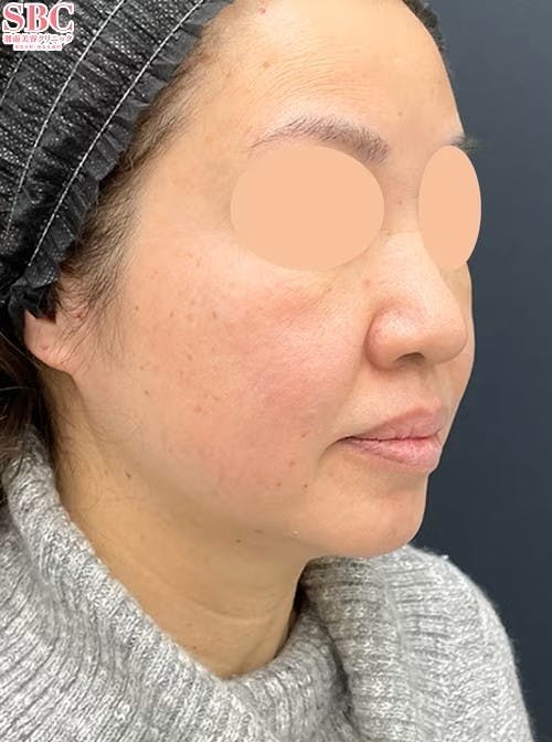 【女性・輪郭】Aquicell（アキーセル）脂肪吸引 メーラーファット除去術 ジョールファット除去術_before