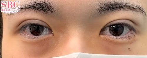 【20代男性・目元】週末二重(R)_justafter