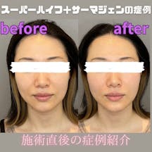 【女性・たるみ】スーパーハイフ2とサーマジェン_before_aftar