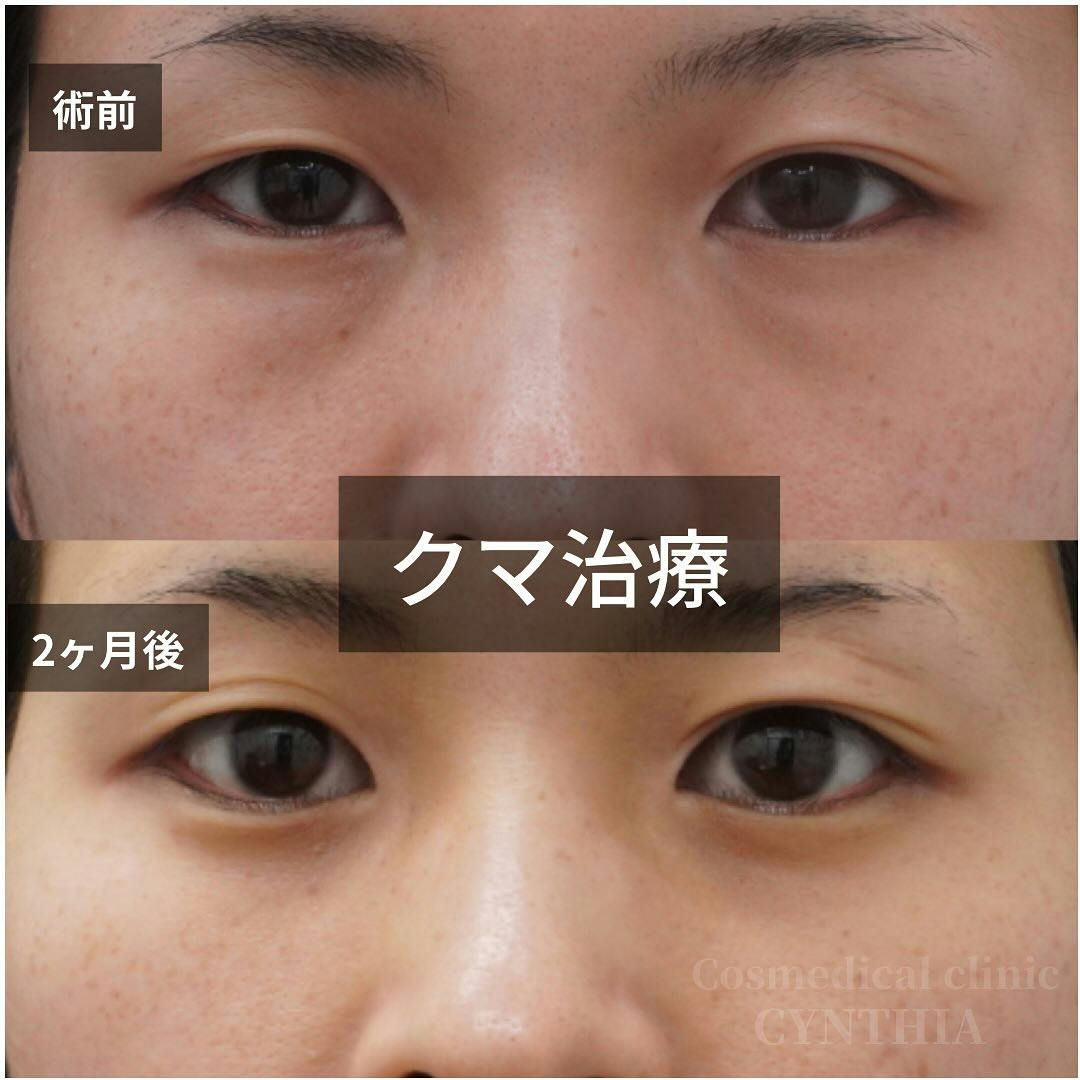 【30代女性・目元】目の下のクマ・たるみ取り_before_aftar