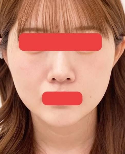 品川美容外科 心斎橋院で糸リフト：美肌アモーレを受けたOkamootyさんの写真