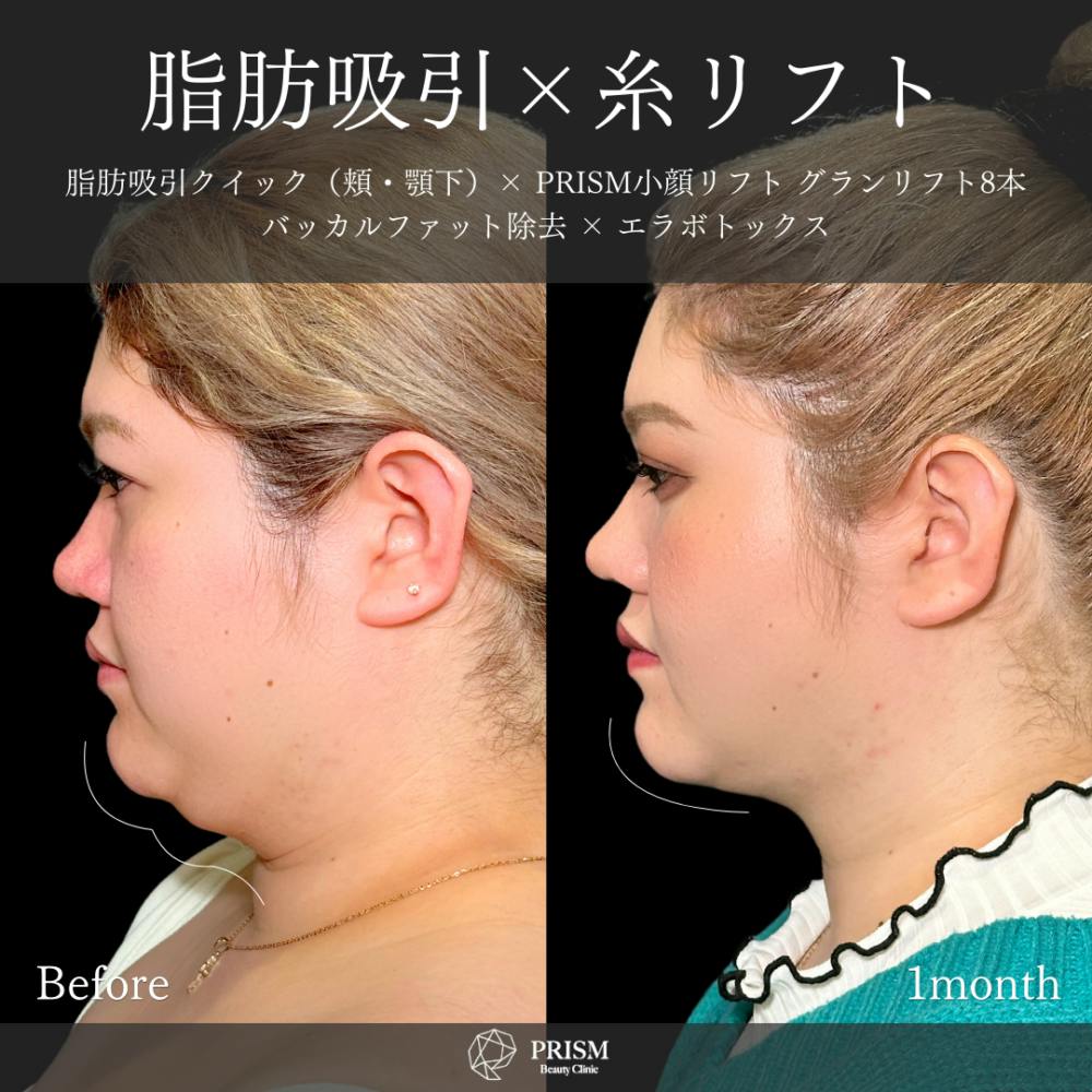 【20代女性・顔】脂肪吸引クイック（頬・顎下）＋糸リフト＋バッカルファット除去＋ボトックス注射（エラ）_before_aftar