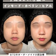 【女性・小顔】オーダーメイド小顔治療_before_aftar