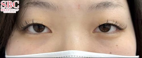 【女性・目元】線留めクロス二重術_before