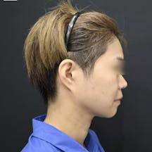 【女性・小顔】美ボディ脂肪吸引_after