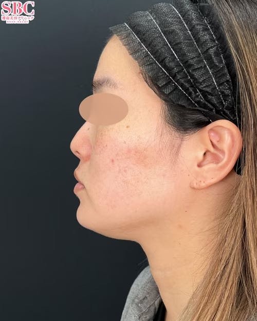 【女性・小顔】根こそぎVASER脂肪吸引_before