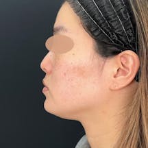 【女性・小顔】根こそぎVASER脂肪吸引_before