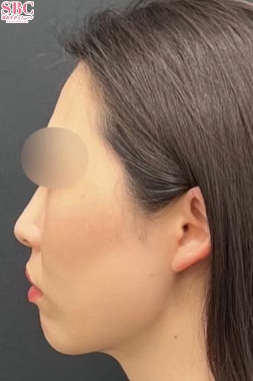 【30代女性・顔】根こそぎVASER脂肪吸引、あざむくみ抑制ドレナージュ、プリマリフト_after