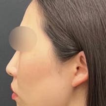 【30代女性・顔】根こそぎVASER脂肪吸引、あざむくみ抑制ドレナージュ、プリマリフト_after