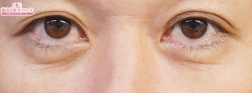 【たるみ】目の下の切らないクマ・たるみ（ふくらみ）取り、切開ハムラ(表ハムラ)法、裏ハムラ法_after