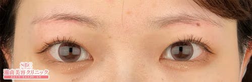 【女性・目元】眉下リフト（眉下切開）_after