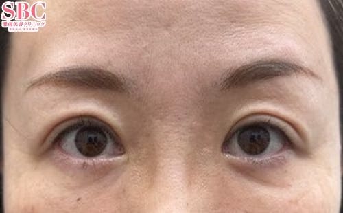 【女性・目元】週末二重(R)_after