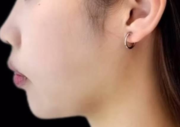 ユザワクリニック(yuzawa clinic)で小顔手術：顎先脂肪注入+顎下脂肪吸引を受けたLINOさんの写真