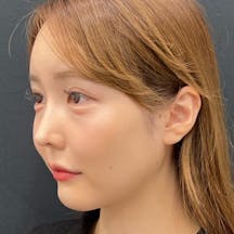 【20代女性・顔】Aquicell(アキーセル)脂肪吸引、ジョールファット除去術、メーラーファット除去術、エンブレイスRF、目の下の切らないたるみ取り、コンデンスリッチフェイス、糸リフト_before