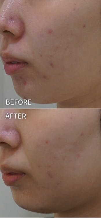 【女性・ニキビ】ダーマピールセレクション ジェネシス_before_aftar