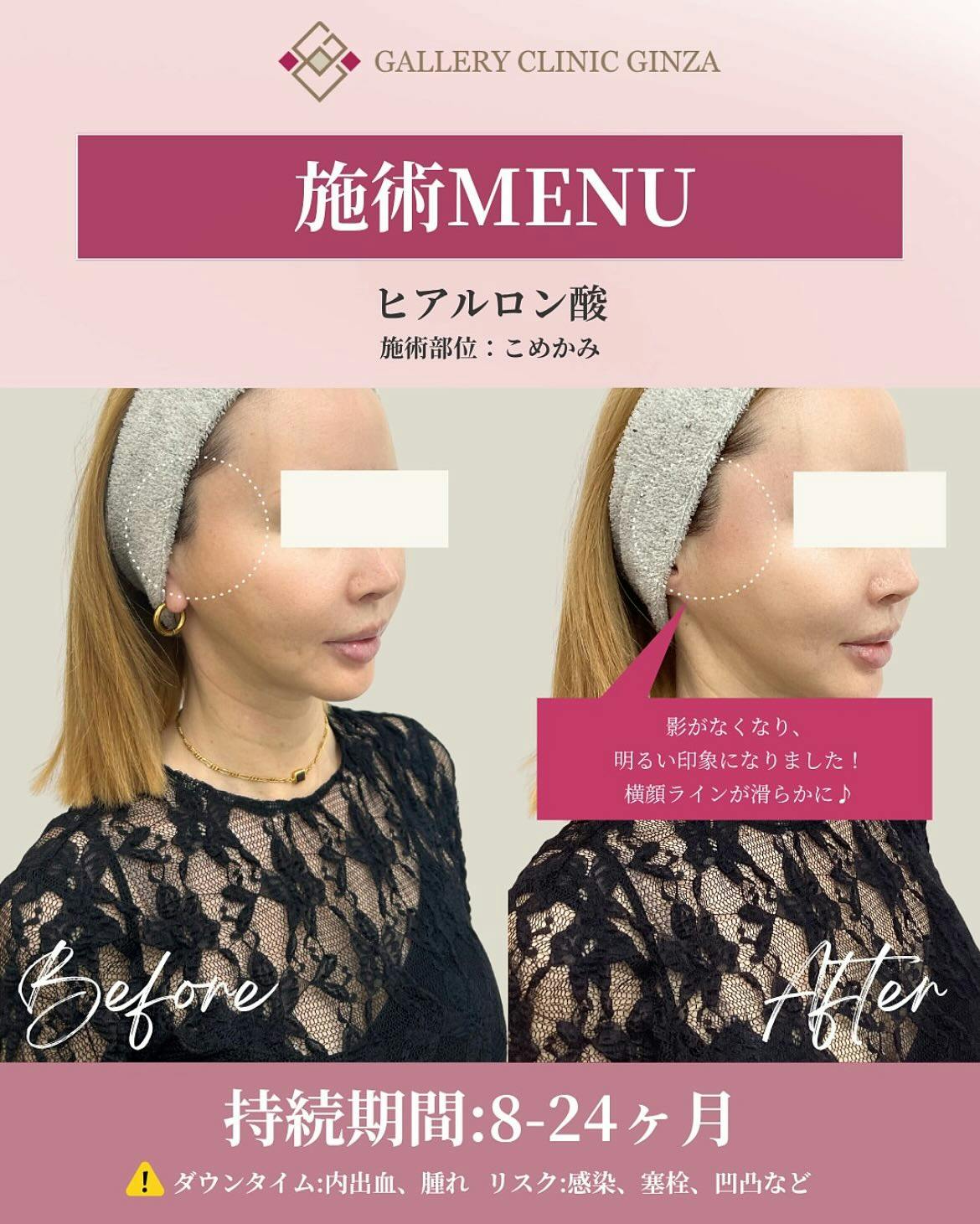 【女性・凹み】ヒアルロン酸(こめかみ)_before_aftar