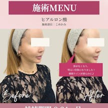 【女性・凹み】ヒアルロン酸(こめかみ)_before_aftar