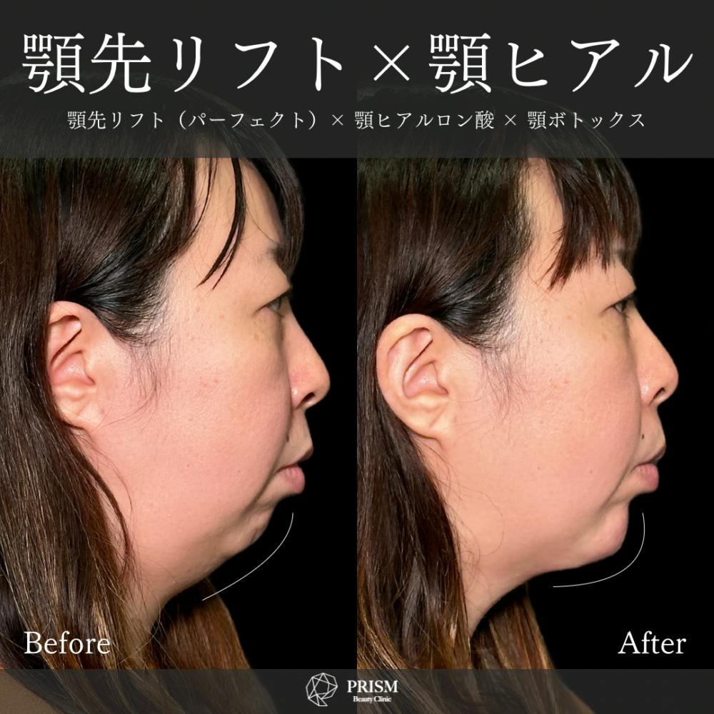 【30代女性・顎】あご先リフト＋ ヒアルロン酸（顎）＋ボトックス（顎）_before_aftar