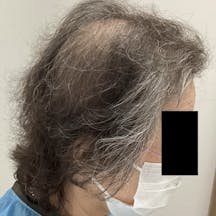 【71歳女性・頭髪】薄毛治療_before