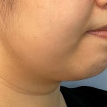 【女性・輪郭】根こそぎVASER脂肪吸引、あざむくみ抑制ドレナージュ_before