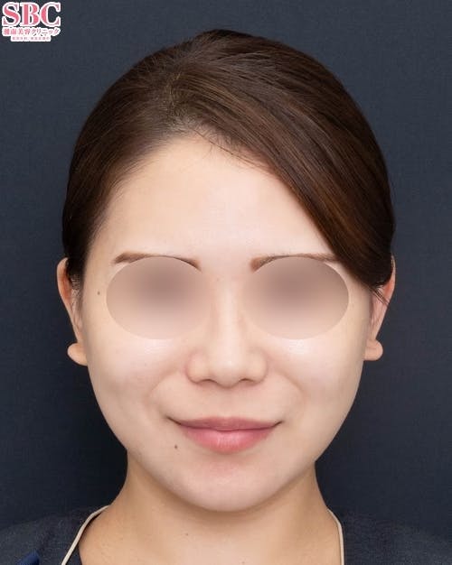 【20代女性・顔】Aquicell（アキーセル）脂肪吸引、根こそぎVASER脂肪吸引、ボトックス、SBCプリマリフト_after