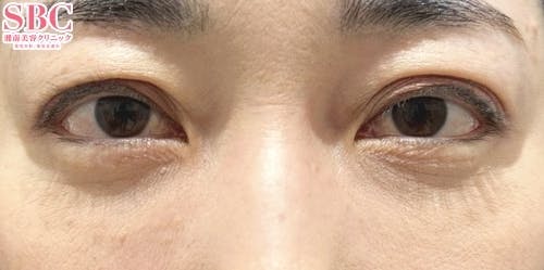 【40代女性・目元】目の下の切らないクマ・たるみ（ふくらみ）取り、ナチュラル脂肪注射ナノリッチ、ナチュラル脂肪注射コンデンスリッチ_after