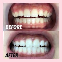 【歯】オフィスホワイトニング_before_aftar