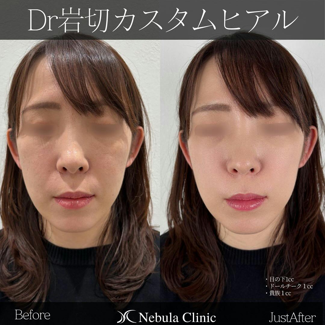 【女性・目の下・頬・小鼻】ヒアルロン酸注入(目の下・ドールチーク・貴族)_before_aftar