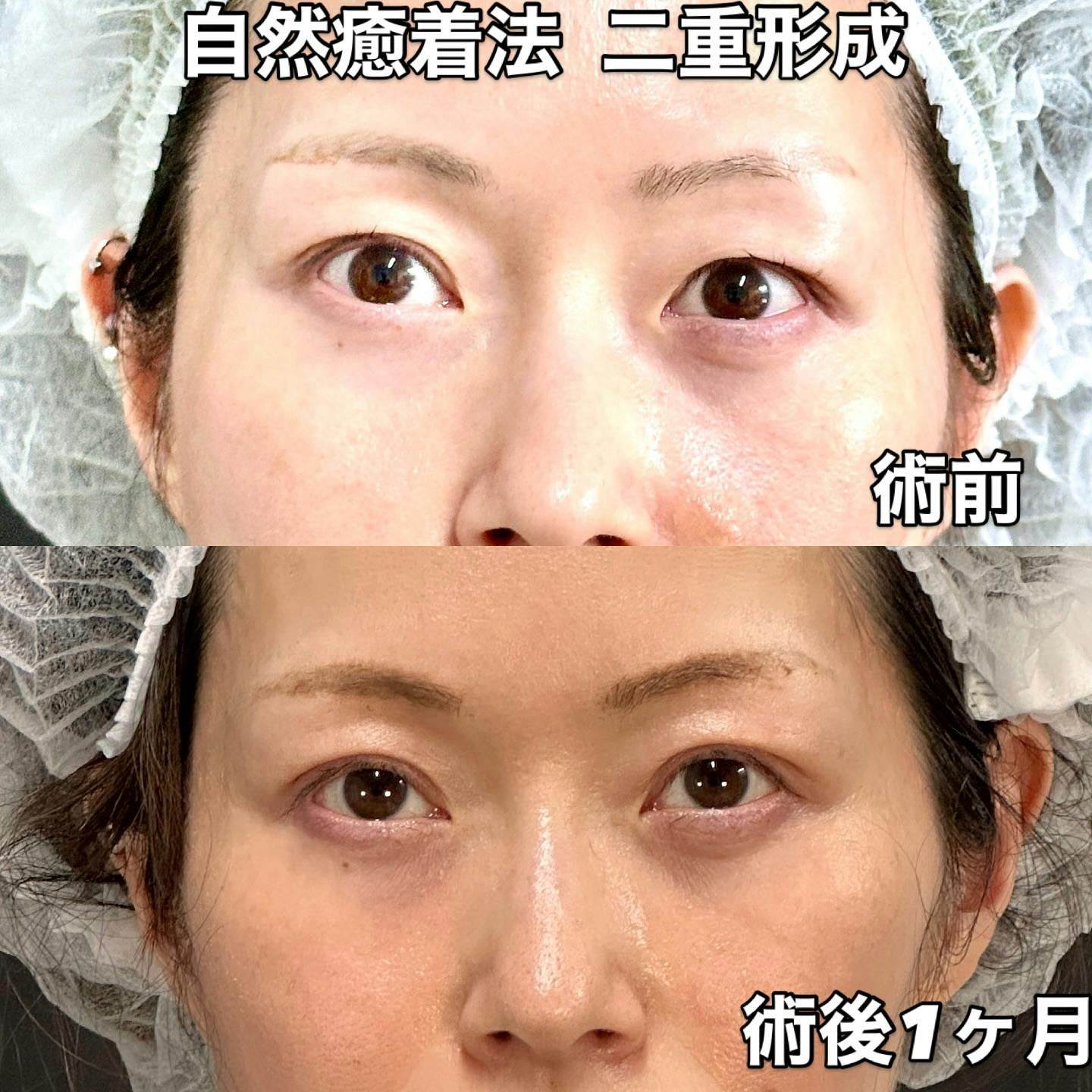 【女性・目元】自然癒着法二重形成_before_aftar